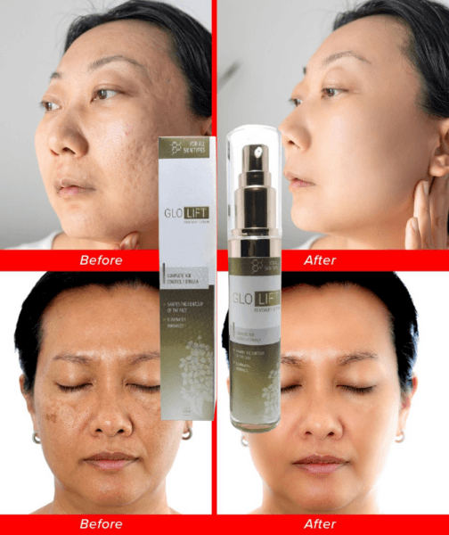 Harga GloLift di Indonesia – Di Mana Dijual